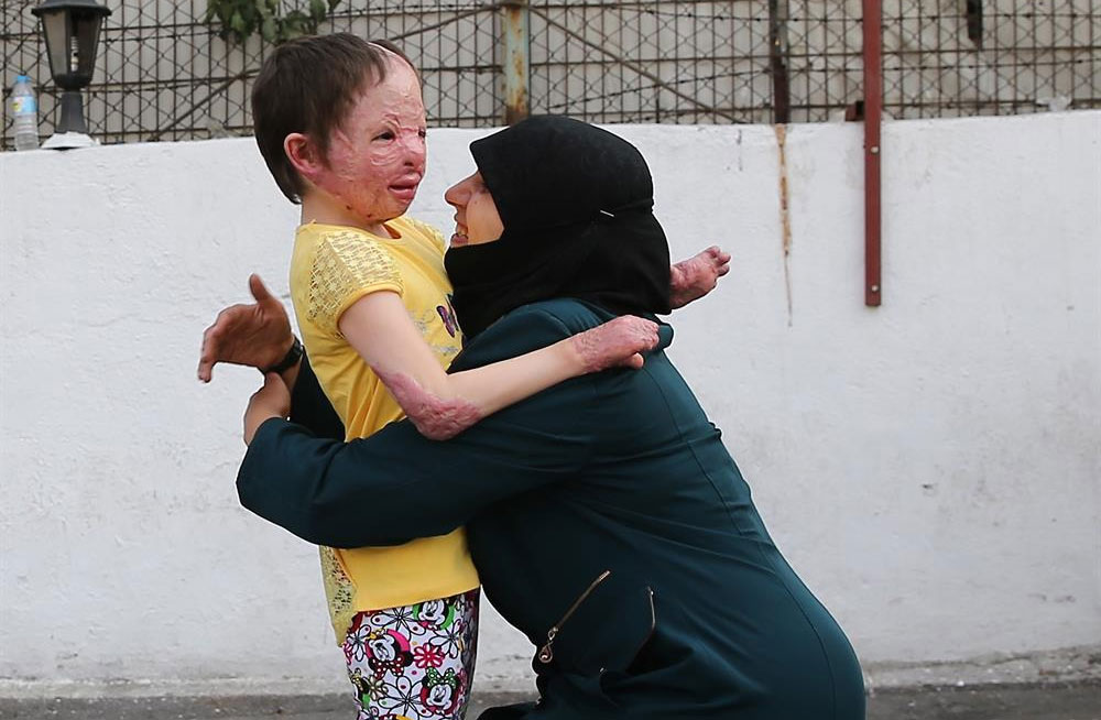 إسطنبول جمعتها بأمها.. دموع فرح "هبة" السورية أطفأت لهيب حروق وجهها