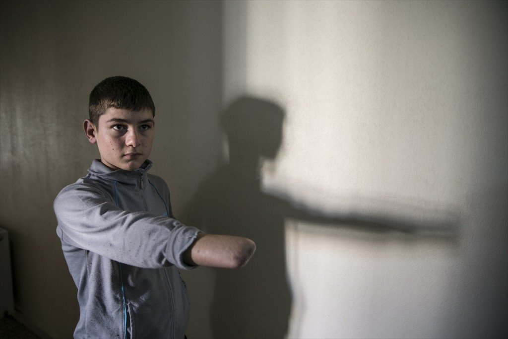 شاهد: الطفل السوري “يوسف زياد” والذي يأمل بالحصول على يد اصطناعية في تركيا (صور + فيديو)