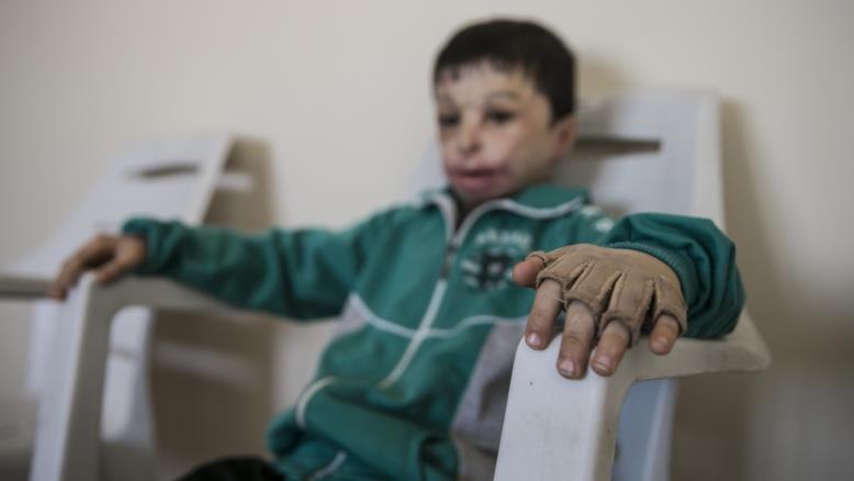 طفل سوري في تركيا يكافح لإزالة حروق براميل الأسد .. (صور قاسية)