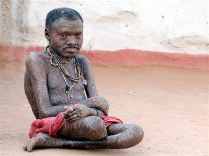 لن تصدق ما ستراه.. رجل هندي يتغير جلده مثل الثعابين كل 10 أيام (شاهد الصور)