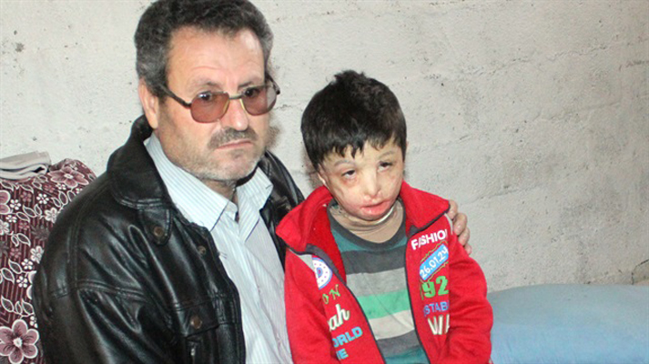 الطفل السوري “محمود” أحرقته براميل النظام وينتظر العلاج في تركيا