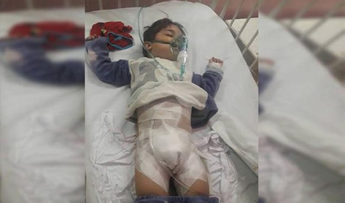 طفل سوري يفقد عضوه بالكامل بدلاً من تطهيره