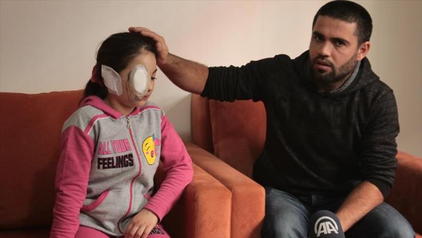 بعد تشوّهها.. الطفلة السورية “لجين” بانتظار وجهها الجميل