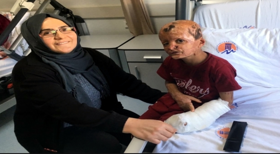 تركيا: اجراء عملية جراحية ناجحة للطفل السوري محمد