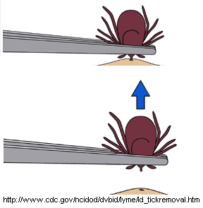 طريقة إزالة حشرة القراد