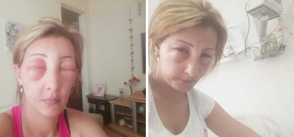 تركيا: كادت أن تفقد بصر ها بسبب صبغة الشعر