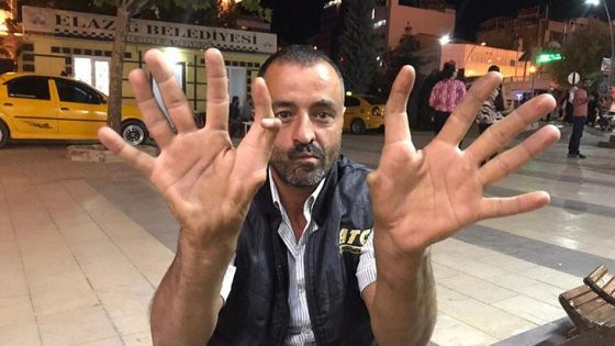 مواطن تركي لديه 11 إصبع و لدى طفله 13 إصبع و الأطباء يكشفون عن سبب صادم..!!