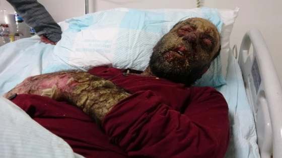 إصابة رجل بفيروس كورونا تتسبب في ظهور مرض نادر يُغيِّر ملامح وجهه في أرضروم! (فيديو)